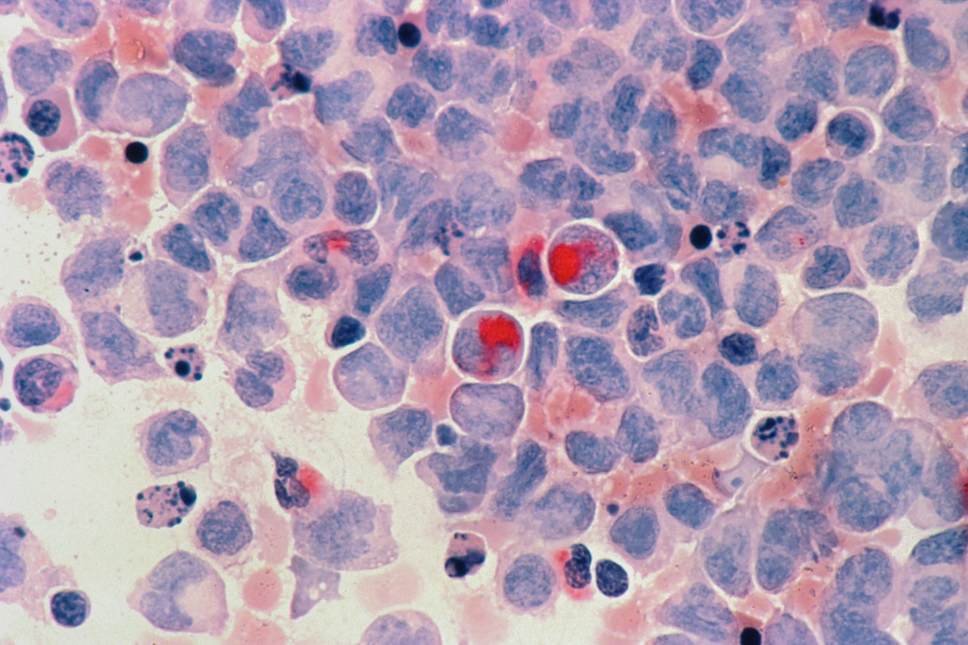 Vue microscopique publiée par le National Cancer Institute. Illustration de la recherche.